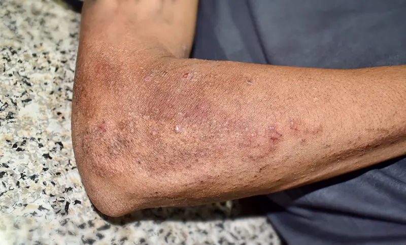 Pellagra Understanding Symptoms and Treatment